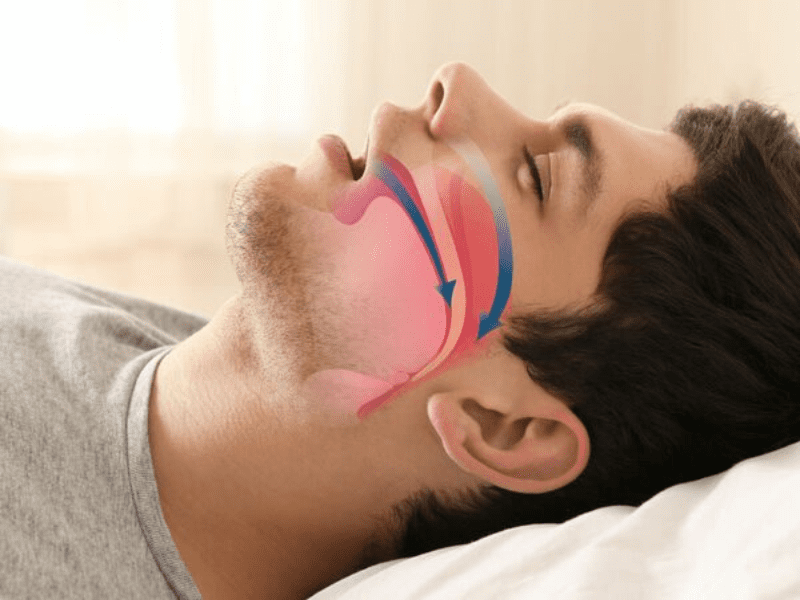 Uvulopalatofaringoplastia